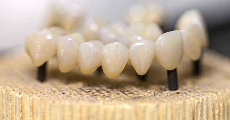 veneer teeth