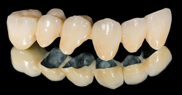 Step by Step: Preparing a Tooth for a Crown - Family Dental of Teravista